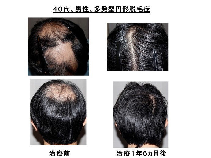 円形脱毛症　病院
